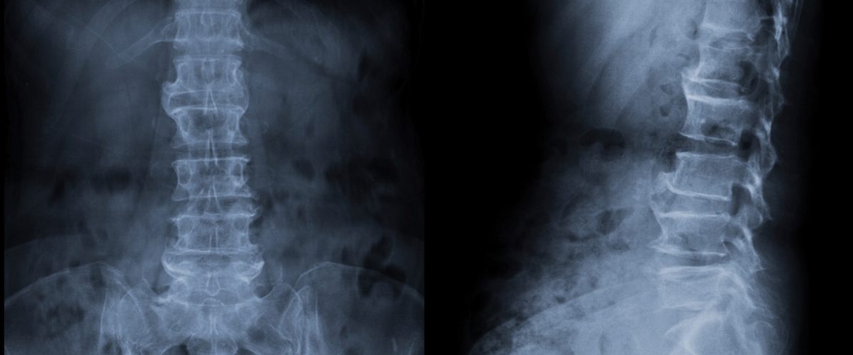 ALIF Fusão Intercorporal Lombar Anterior