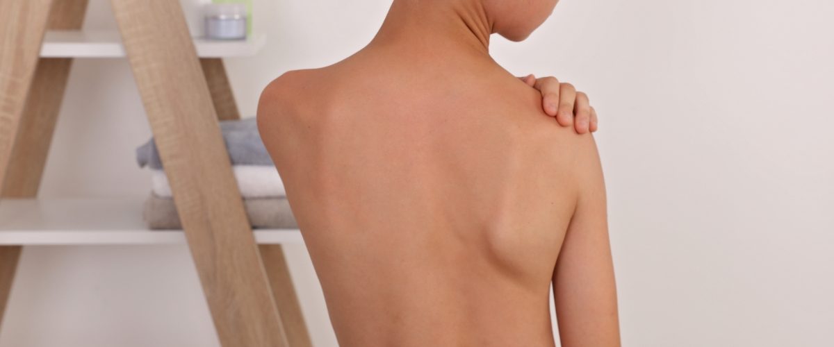 menino com escoliose