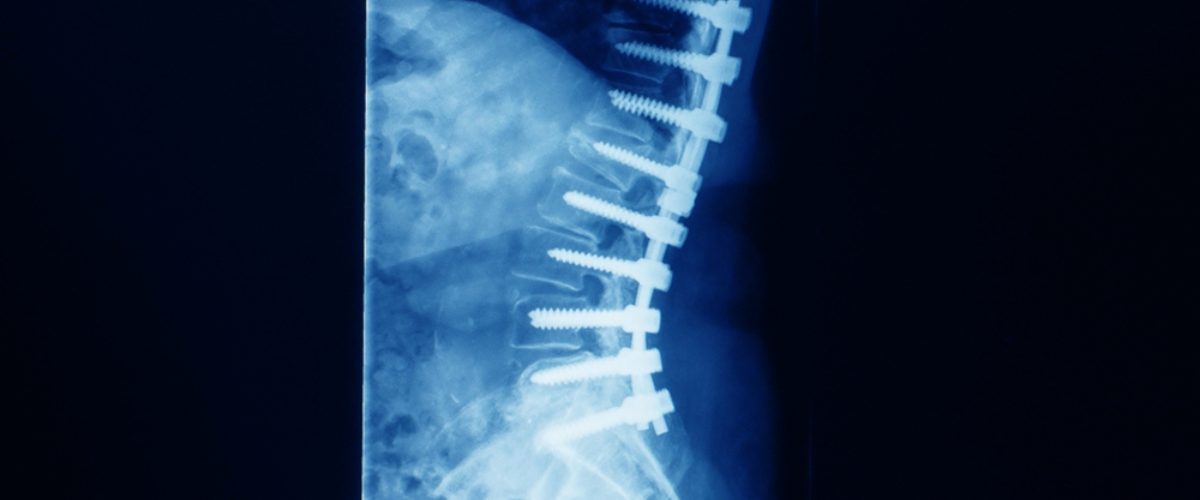 LLIF Fusão Intercorporal Lombar Lateral