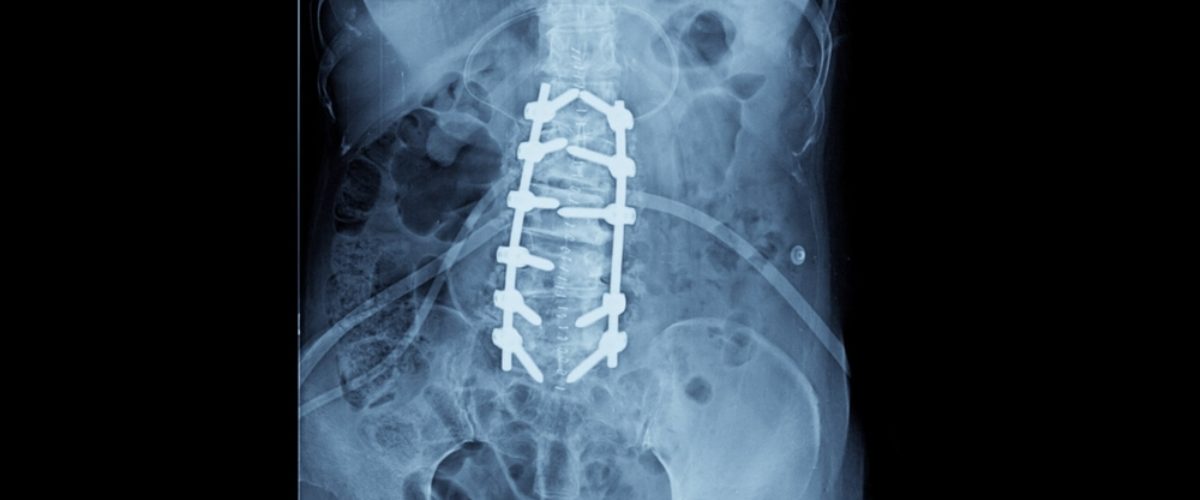 Tratamento de uma deformidade na coluna